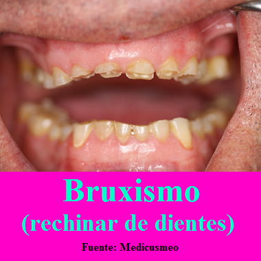 Bruxismo (rechinar de dientes)